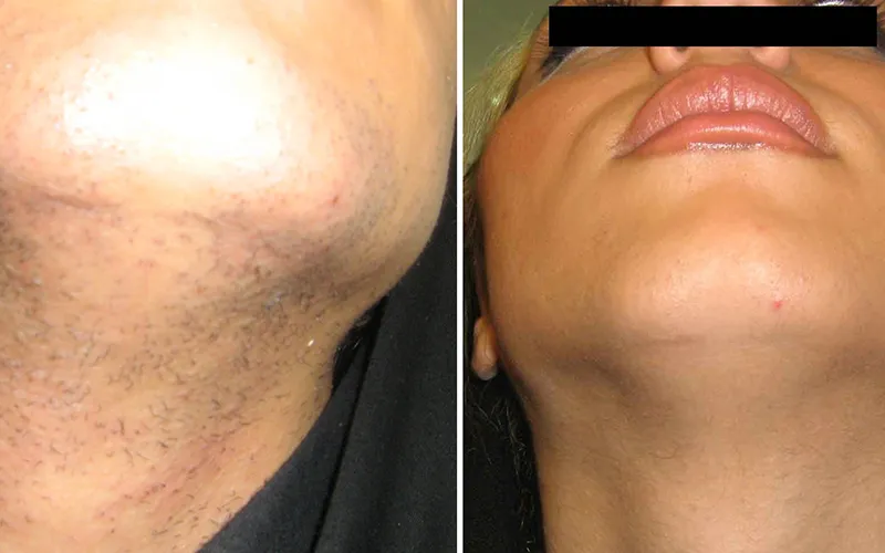 لیزر موهای زائد کلینیک دکتر عسگری