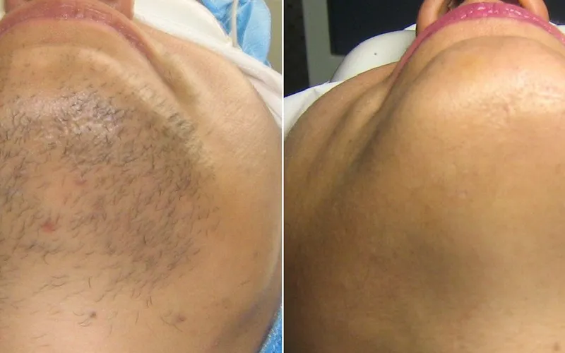 لیزر موهای زائد